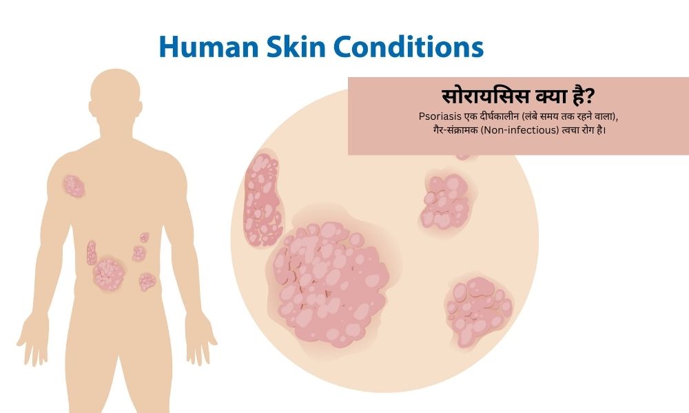 सोरायसिस – सोरायसिस क्या है? आयुर्वेदिक उपचार