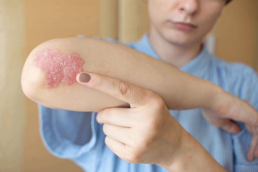 Embracing Ayurvedic Dietary Remedies: A User's Guide to Eczema Relief