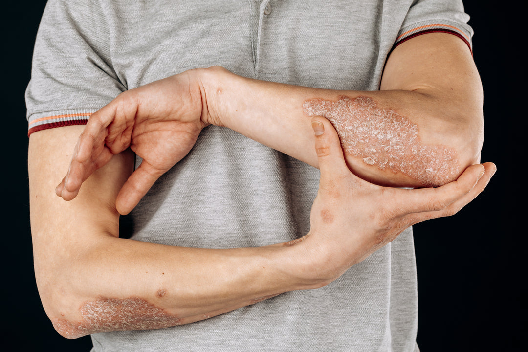 Effective Ways to Get Ready for Seasonal Changes when you have Psoriasis