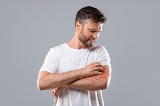 A man with psoriasis scratching his hands, seeking natural relief.