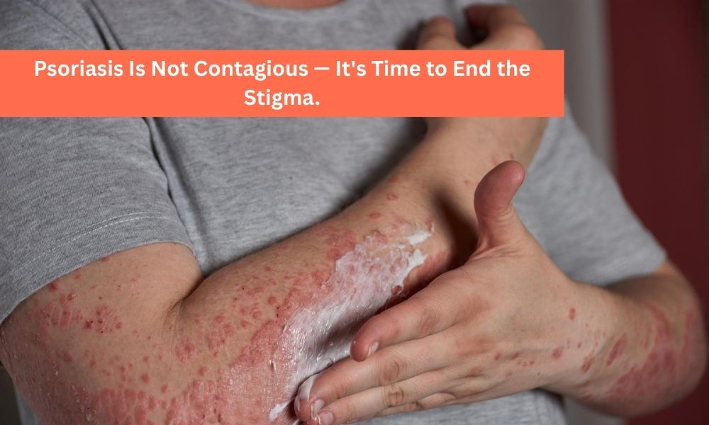 Can Psoriasis Spread by Touch?