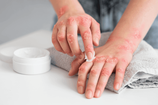 The Role of Moisturizers in Alleviating Psoriasis Flare-ups